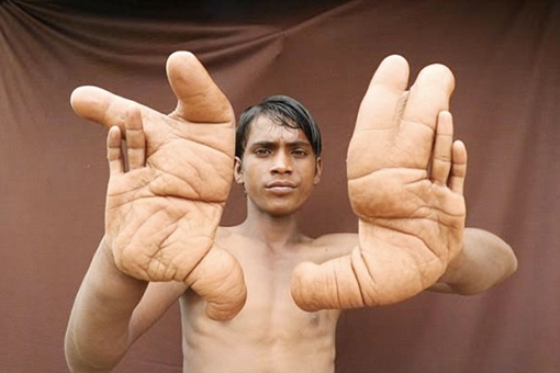 Cậu bé Ấn Độ mắc bệnh "quỉ ám" khiến mọi người khiếp sợ