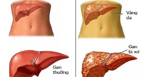 Bảo vệ, phục hồi tế bào gan sớm – Mấu chốt duy trì sức khỏe đường dài cho gan