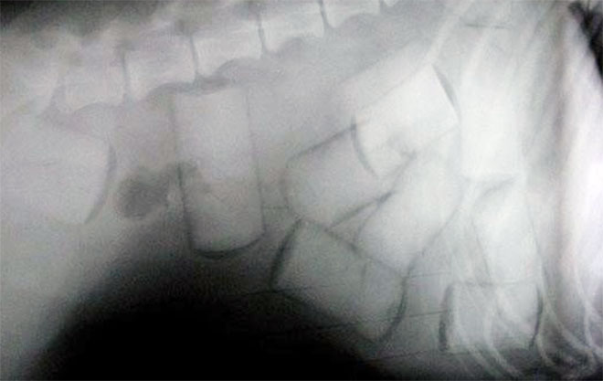 Colombia bắt nhiều nghi phạm nuốt hàng triệu USD tiền từ bán ma túy vào bụng