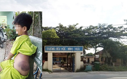 Đình chỉ công tác 15 ngày đối với giáo viên đánh học sinh lớp 1 bầm tím người