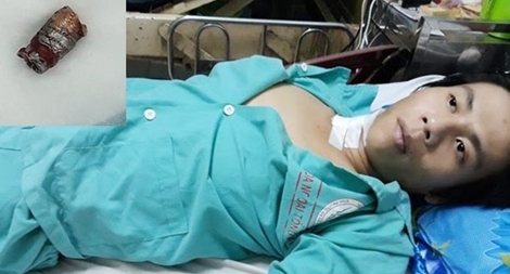 Suýt chết vì bị súng bút bắn đạn ghim cổ 