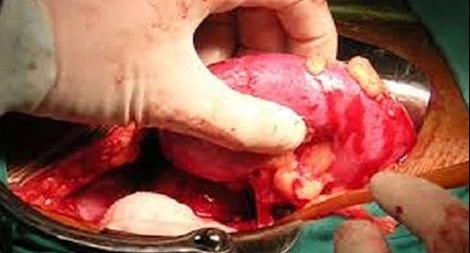 Tìm bị hại trong vụ mua bán bộ phận cơ thể người