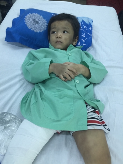 Xót xa bé trai 4 tuổi bị cha mẹ bạo hành đến gẫy xương đùi