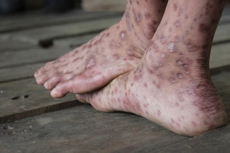 “Bệnh lạ” tái phát ở huyện miền núi Sơn Hà