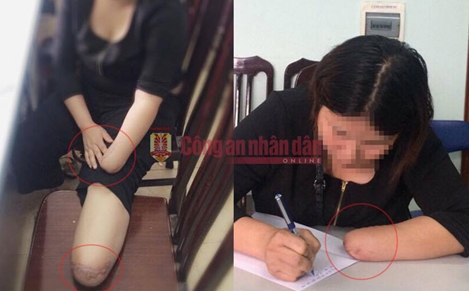 Vụ thuê người chặt chân, tay để trục lợi bảo hiểm: Có dấu hiệu tội "Cố ý gây thương tích"