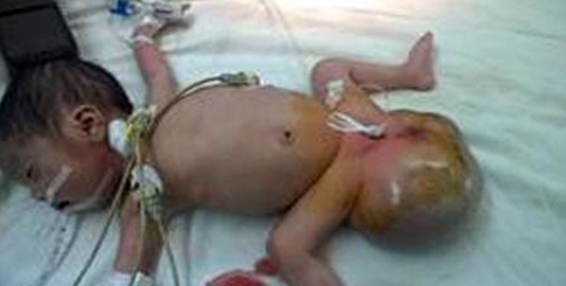 Phẫu thuật thành công khối u 1,7kg cứu sống trẻ sơ sinh