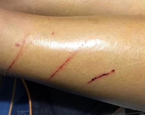 Xác minh thông tin kẻ biến thái rạch đùi nữ sinh tại Hà Nội