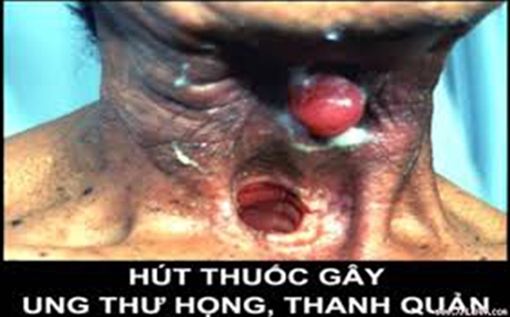 Hút thuốc lá, phá hủy đường hô hấp, rước bệnh ung thư