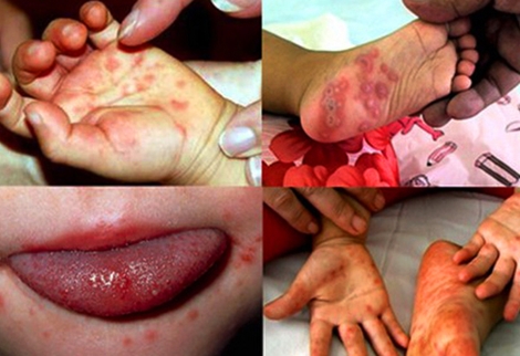 Bệnh tay chân miệng vẫn diễn biến phức tạp