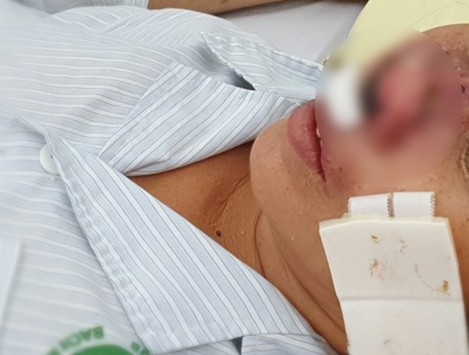 Lại xuất hiện bệnh lạ “ăn” cánh mũi, 4 người đã tử vong