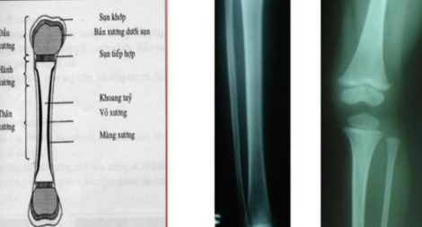 Giám định tuổi người sống để làm rõ nghi án