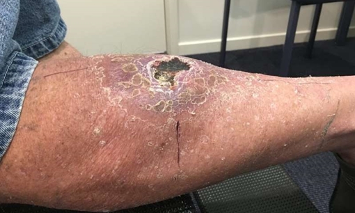 Australia đau đầu vì nạn dịch lở loét "ăn thịt người" lây lan