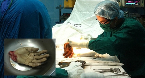 Hơn 4 giờ căng thẳng cứu bàn tay bị đứt lìa cho một công nhân