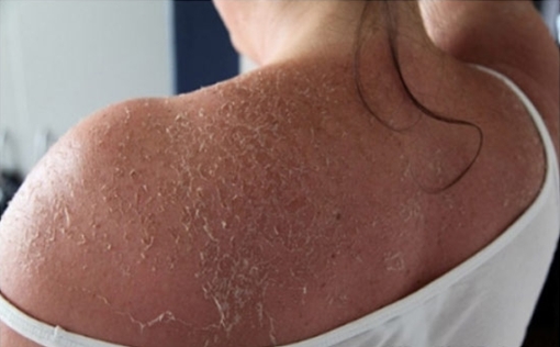 Tẩy trắng da cấp tốc - mối nguy hại khôn lường