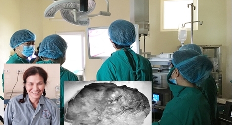 Nữ bệnh nhân bị u tủy khổng lồ hiếm gặp