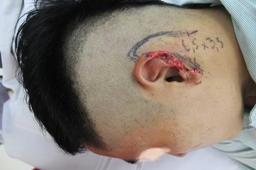 Nam thanh niên bị bạn cắn đứt... tai khi đang nhậu