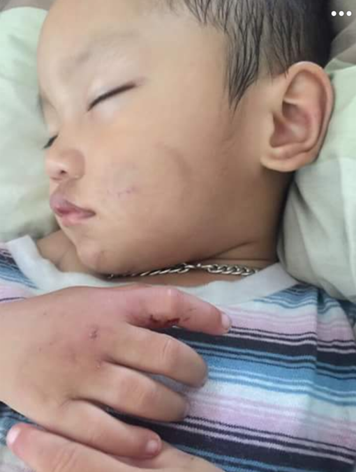 Cháu bé hai tuổi nghi bị bạn trai của mẹ ruột đánh đập