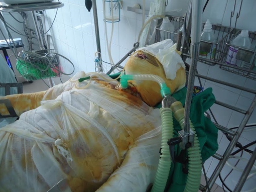 Đôi vợ chồng trẻ bỏng nặng vì tàn thuốc lá