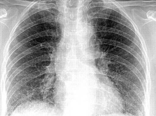 Thông tin bệnh nhân ở Tây Ninh nhiễm virus Corona là sai sự thật