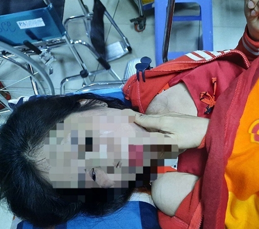 Điều tra người phụ nữ nghi bị chồng hờ bạo hành dã man