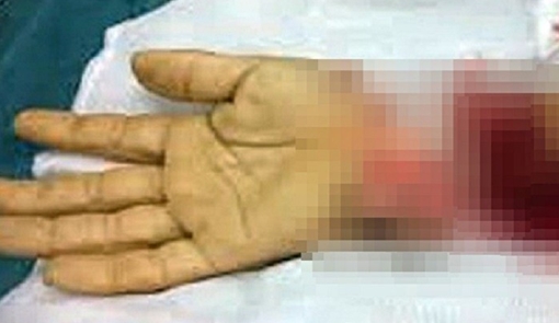 Tạm giữ kẻ chém đứt lìa bàn tay người khác