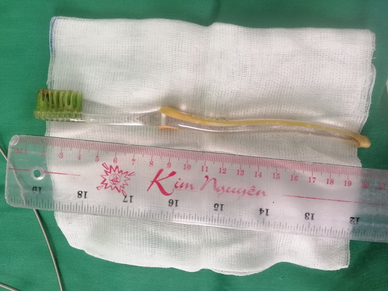 Lấy bàn chải đánh răng nằm trong bụng bệnh nhi 13 tuổi