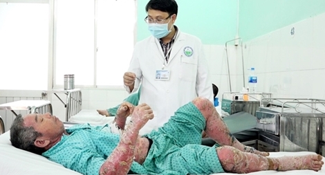 Toàn thân sưng vù, lở loét vì mua thuốc điều trị vảy nến trên mạng