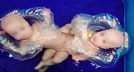 Mổ tách cặp song sinh dính liền phức tạp nhất 