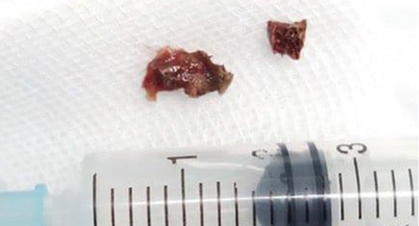 Mảnh xương gà nằm trong phế quản suốt 2 năm