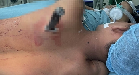 Hai thanh niên bị đâm trọng thương sau tiệc nhậu