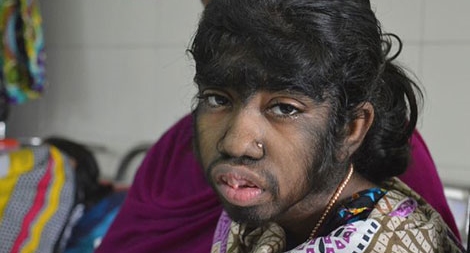 Phận đời bi thảm của những “người sói”