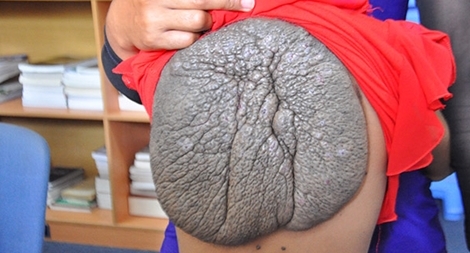 Bé gái 10 tuổi mang căn bệnh "mai rùa" kì dị của thế giới