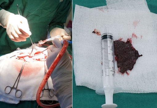 4 giờ phẫu thuật cứu sống thanh niên bị mảnh lưỡi cưa ghim sâu vào đầu