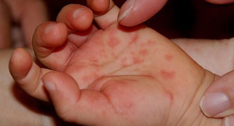 Một tháng ghi nhận hơn 2.000 ca bệnh tay chân miệng