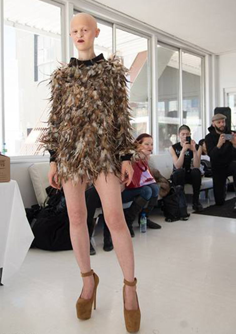 Người mẫu mắc bệnh rối loạn di truyền hiếm gặp