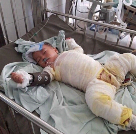 Xót xa cháu bé 20 tháng tuổi bị bỏng nặng