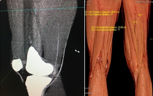 Ứng dụng kỹ thuật dựng hình xác định kích thước gân cơ thon