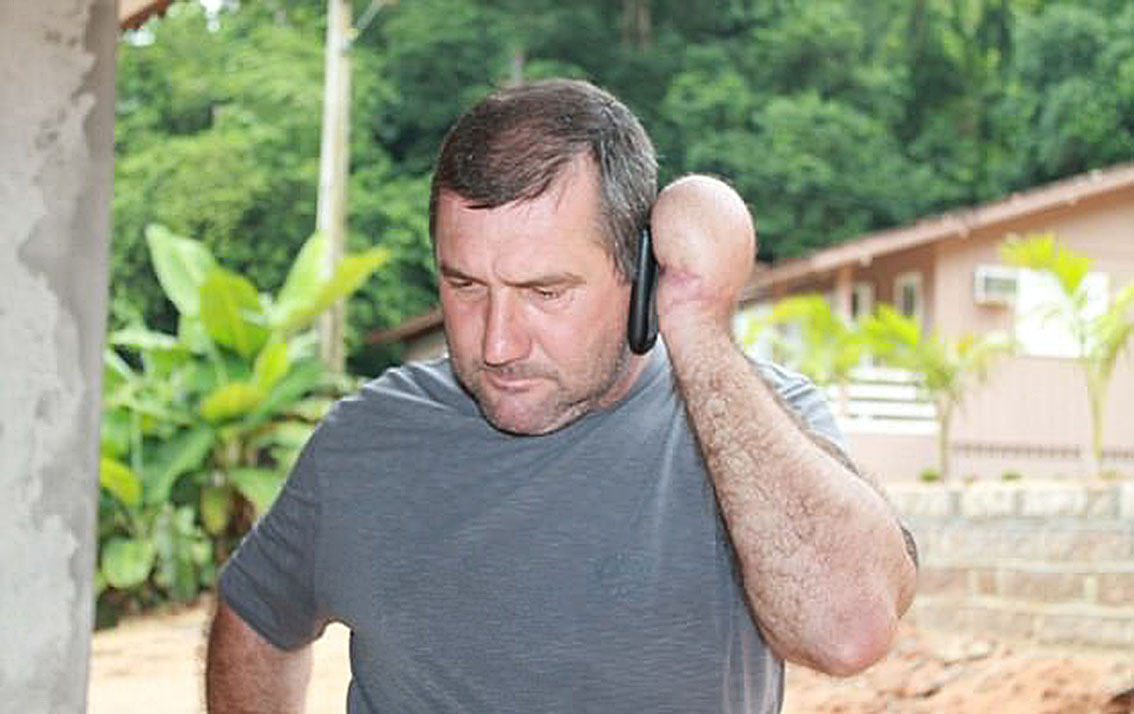 Lần đầu tiên trên thế giới, cánh tay được khâu vào bụng để nuôi sống