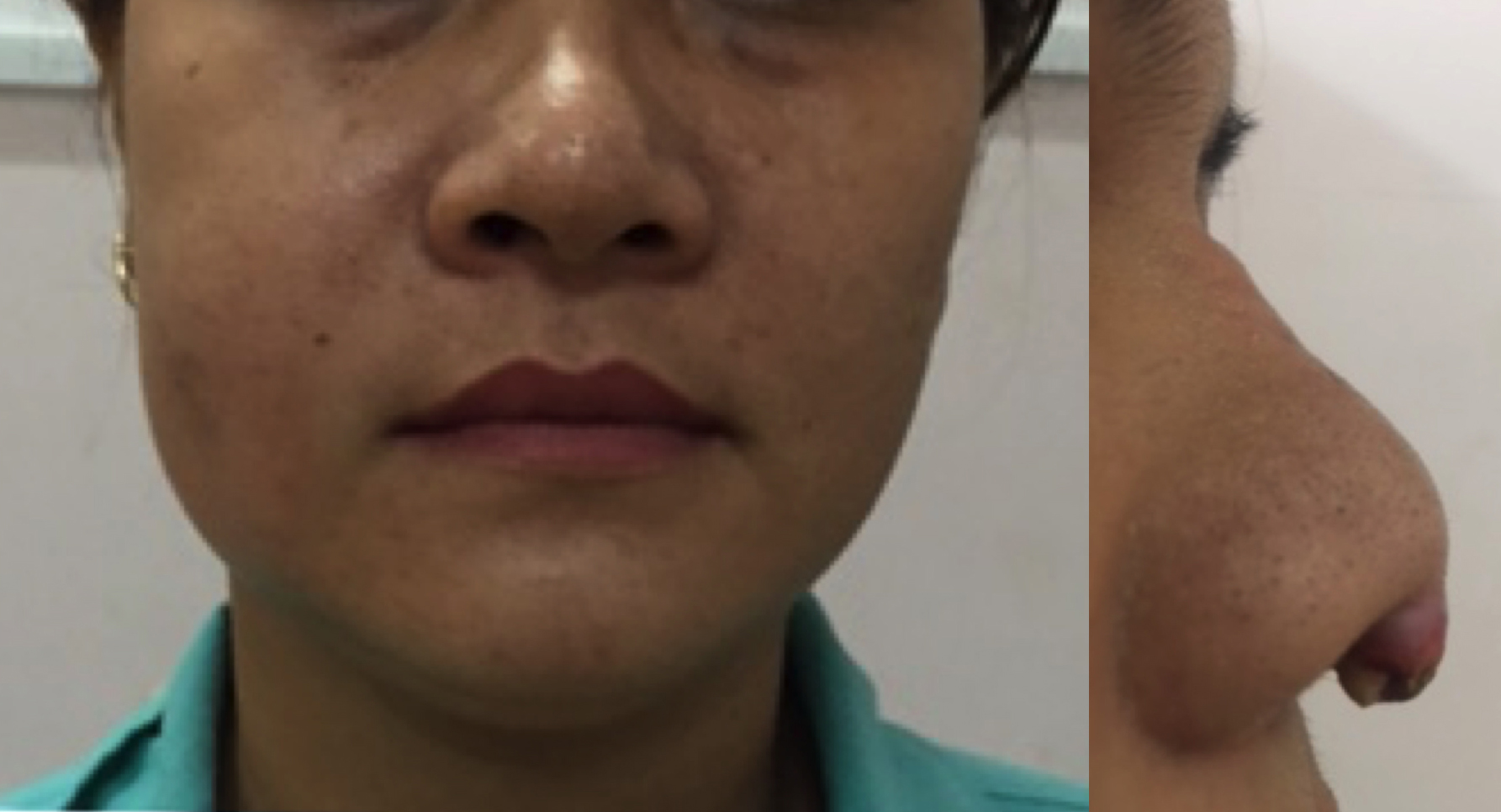 Những "ngộ nhận" dẫn tới thảm họa sau làm đẹp