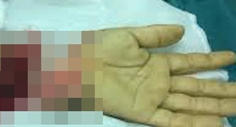 Khách hát Karaoke chém đứt lìa bàn tay nhân viên quán 