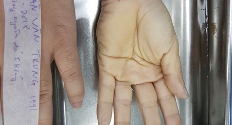  Ghép nối thành công bàn tay bị đứt lìa cho bệnh nhân 