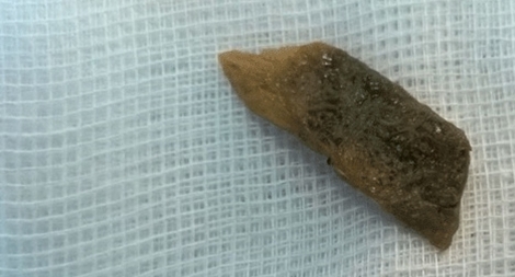 Sống chung với mảnh xương heo dài gần 1cm găm trong phổi suốt hơn 1 năm