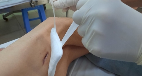 Gia tăng đột biến người nhiễm "vi khuẩn ăn thịt người"