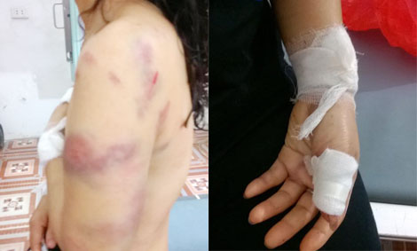 Nỗi ám ảnh kinh hoàng của cô giáo bị chồng cũ bạo hành