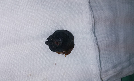 Bé trai bị hoại tử "mầm riềng" vì trò nghịch dại