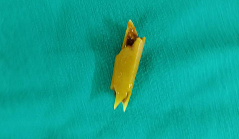 Phẫu thuật cứu sống bệnh nhân bị down nuốt xương gà