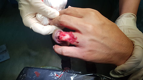 Sự cố hiếm gặp do đeo nhẫn