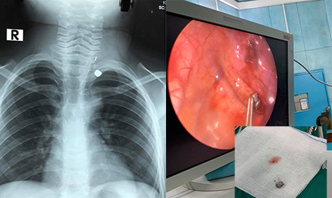 Bé trai suýt mất mạng vì bố bất cẩn trong sử dụng súng 