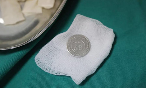 Bé trai hồn nhiên kể chuyện nuốt đồng xu, cả nhà tá hỏa đưa đi viện