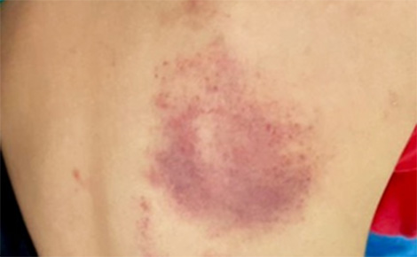 Đình chỉ giáo viên đánh học sinh bầm tím lưng